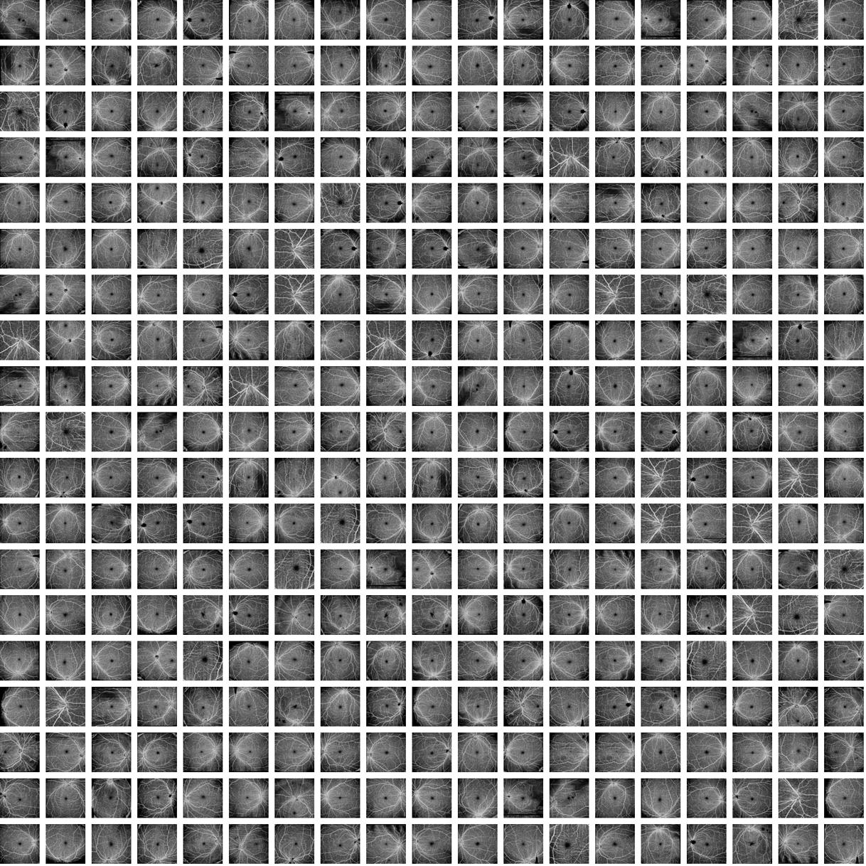 A New Retinal OCT Angiography Diabetic Retinopathy Dataset ...